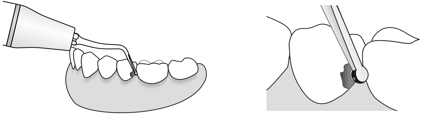 Сфера применения наконечника для скалера